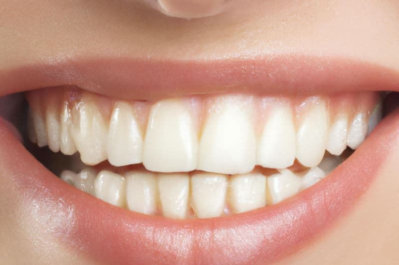 TEETH WHITENING