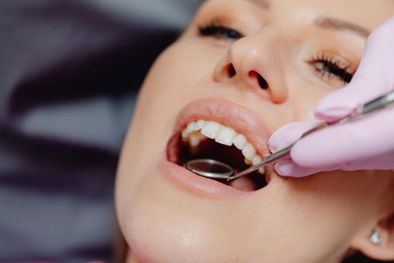 DENTAL VENEERS